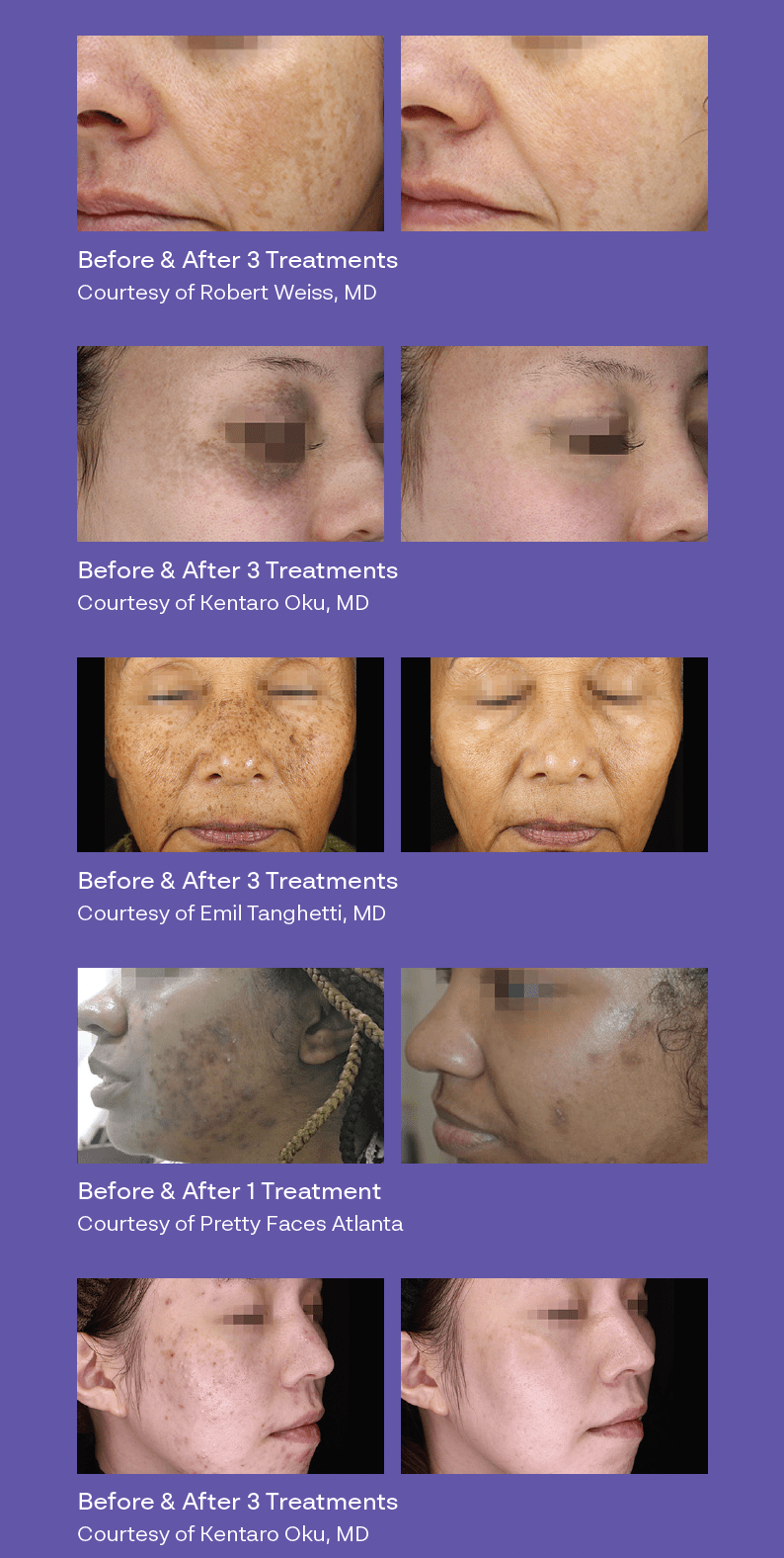 Before & After 4 treatments
